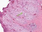 Poxvirus lesions in a wild turkey histo image